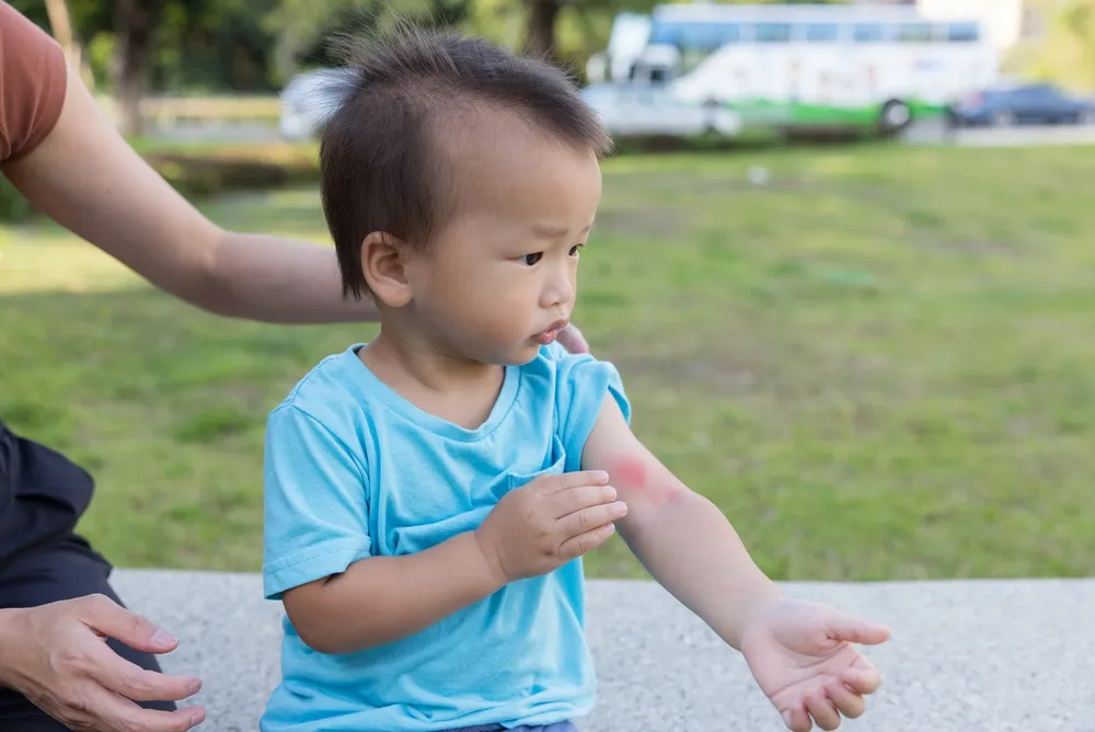 trẻ bị chàm sữa